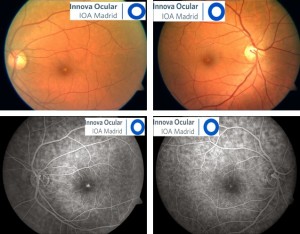 Lesión fótica en ambos ojos después de mirar a un eclipse solar