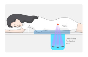 miomas-ilustracion-mujer