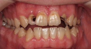 Casos dentales complejos