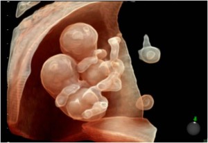 Embarazo gemelar a 8,5 semanas propuesta por el ultrasonido Voluson E10. Foto cortesía de GE