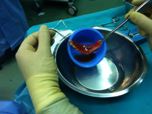 Tendons with stem cells for ligament surgery