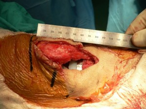 Incision of 8 cm. surgery of total knee prosthesis