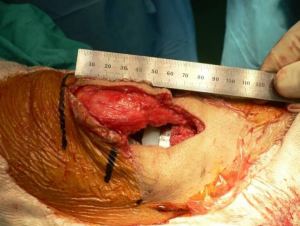Incisión de 8 cm en una cirugía de prótesis total de rodilla