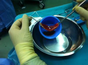 Batea metálica con tendones para la cirugía de ligamentos bañados en células madre