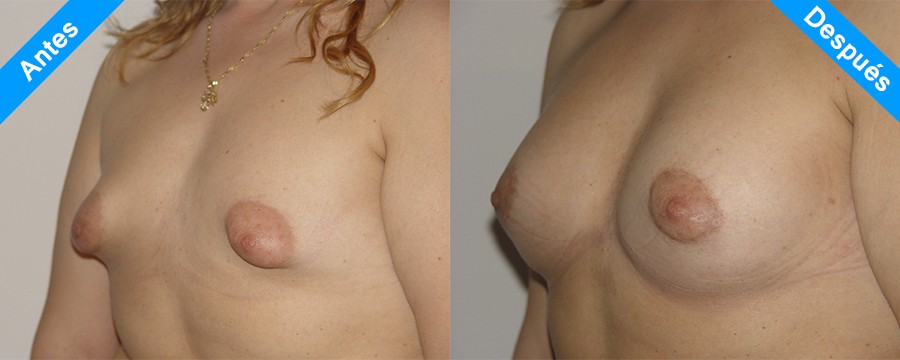 mamas tuberosas antes y despues