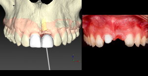 Dientes e Implantes en una sesión