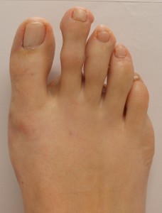 Hallux valgus (después operación)