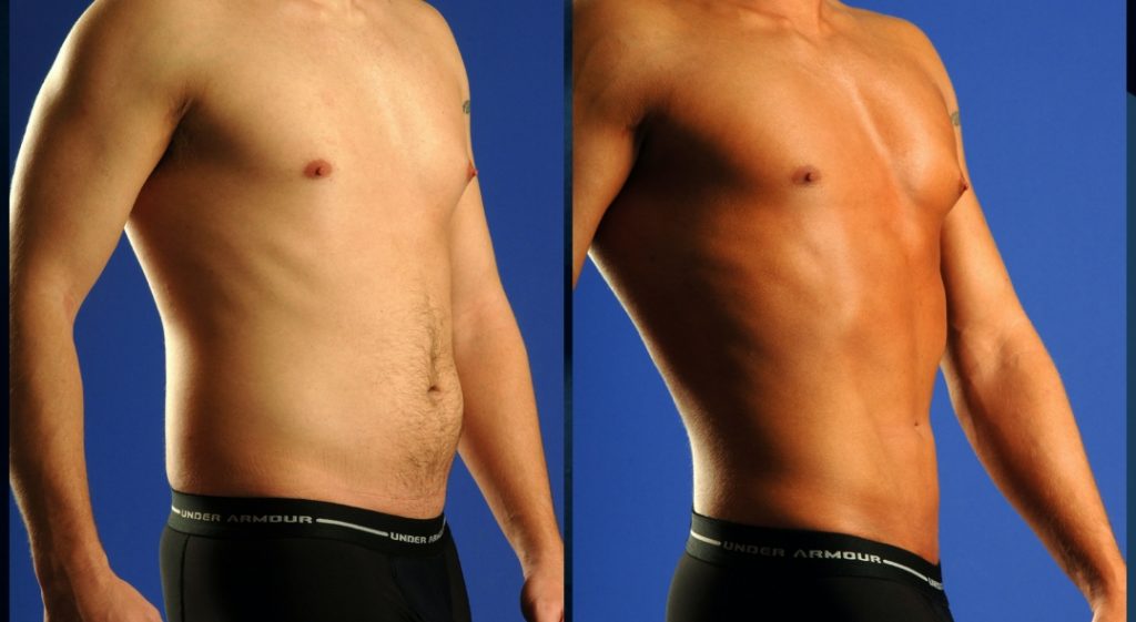 Vaser LIPO liposucción de alta definición Clínica Biyô