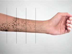 Cómo eliminar tatuajes eficazmente láser