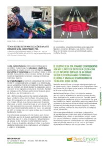 Técnica del Doble Factor novedosa técnica para implantes dentales