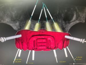 Técnica del Doble Factor novedosa técnica para implantes dentales cirugía virtual