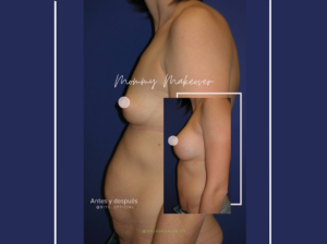 Mommy Makeover antes y después del embarazo biyo salvador