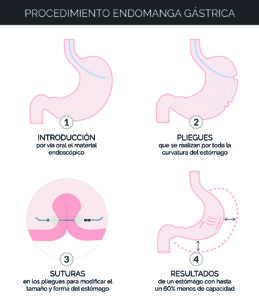 endomanga-reduccion-estomago