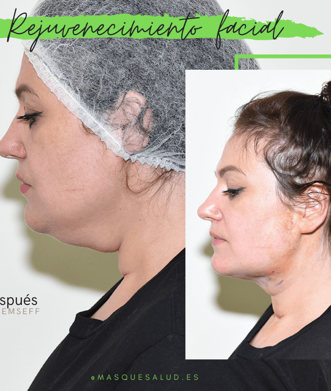 rejuvenecimiento facial con recuperación inmediata mas que salud-min