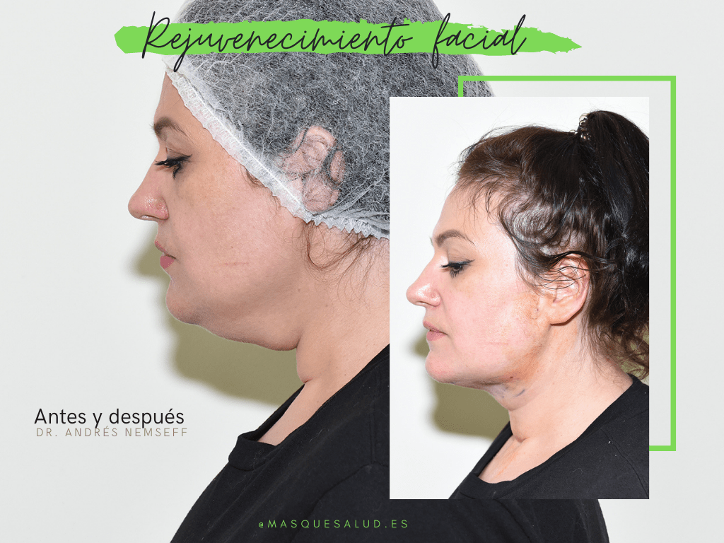 rejuvenecimiento facial con recuperación inmediata mas que salud-min