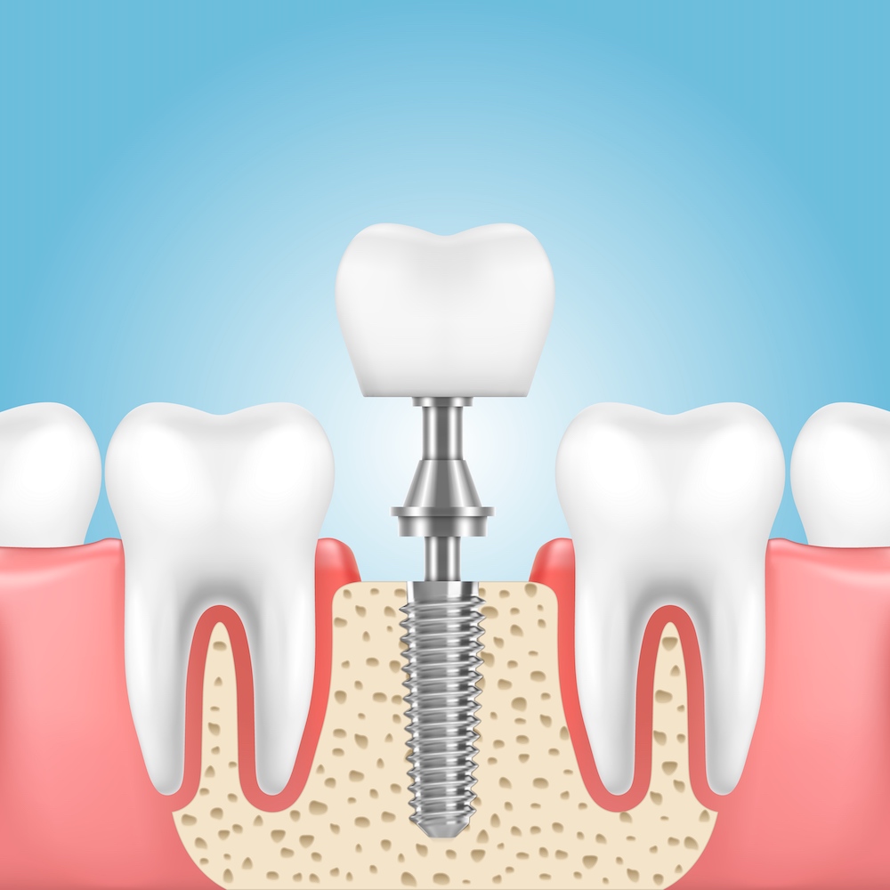 Implantología dental