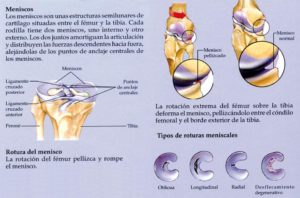 Rotura de menisco ¿Y ahora qúe?